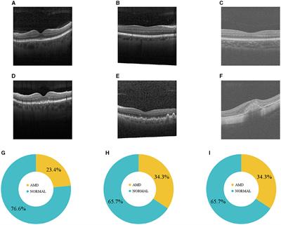 Federated learning for diagnosis of age-related macular degeneration